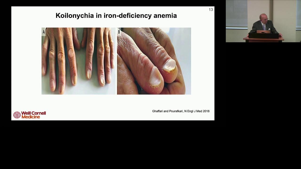 Smooth, diffuse thyroid swelling. Figure 2. Onycholysis (Plummer's nails).  | Download Scientific Diagram